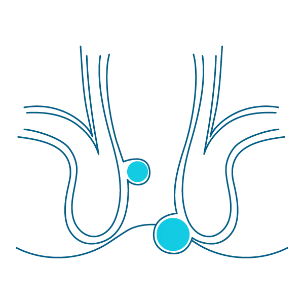 Тромбований геморой